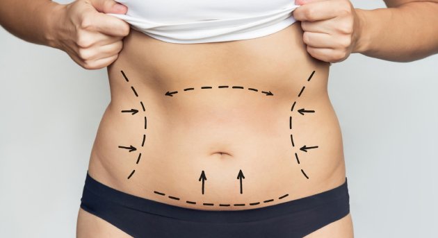 Abdominoplastia en CDMX y Torreón: Recupera la forma de tu abdomen
