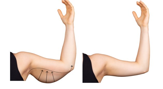 Braquioplastia en CDMX y Torreón