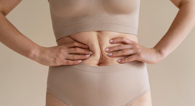 Cirugía postbariátrica en CDMX y Torreón