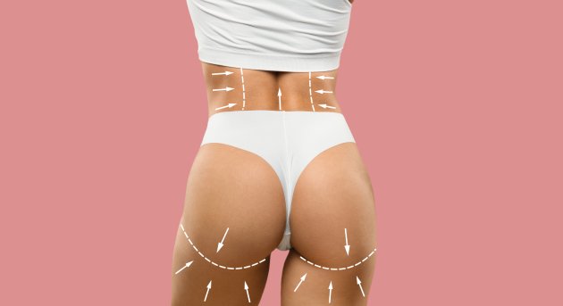 Lipoescultura 360° + BBL en CDMX y Torreón