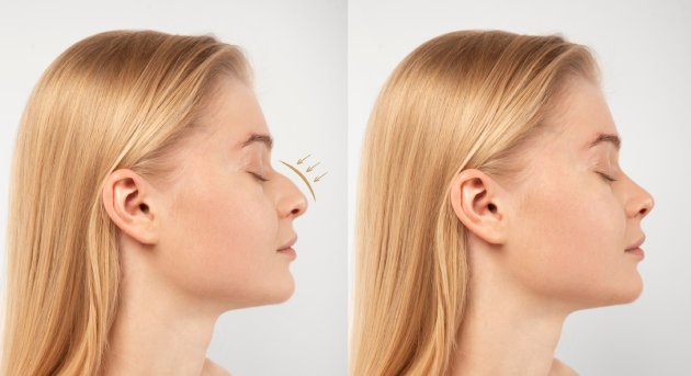 Rinoseptumplastia en CDMX y Torreón